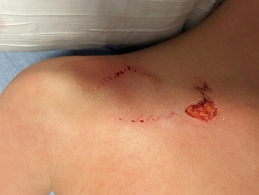A bite received by a 9-year-old in Oak Island on Aug. 23, 2023