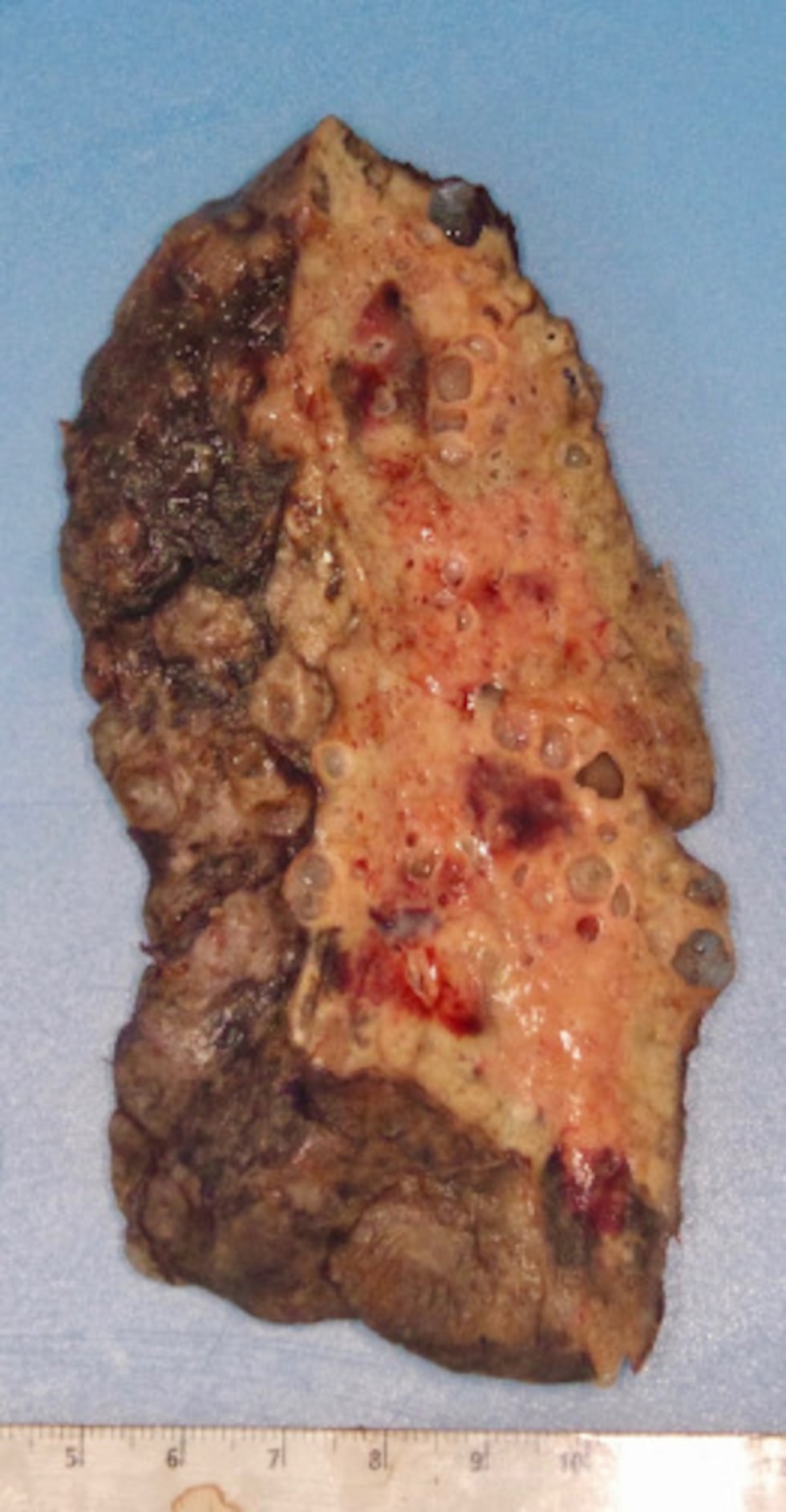 A trauma surgeon on the front lines of COVID-19 is finding lungs infected with the virus are...